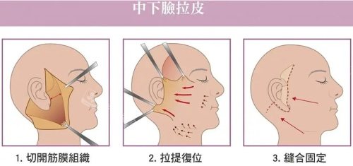 拉皮手術(shù)示意圖 拉皮手術(shù)示意圖