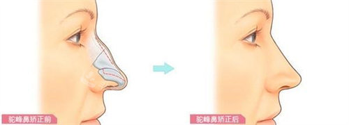 成都米蘭整形醫(yī)院駝峰鼻整形前后對比 成都米蘭整形醫(yī)院駝峰鼻整形前后對比