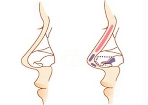 隆鼻示意图