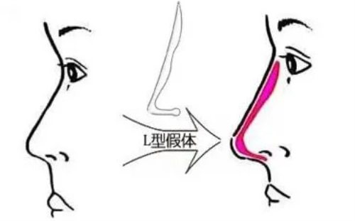 假體隆鼻示意圖 假體隆鼻示意圖