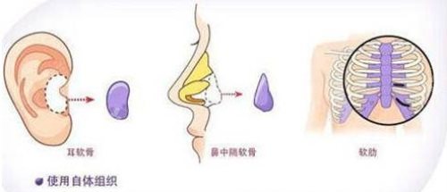 自體軟骨隆鼻示意圖 自體軟骨隆鼻示意圖