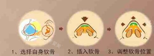 軟骨隆鼻過程圖 軟骨隆鼻過程圖