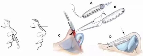 隆鼻過(guò)程示意圖