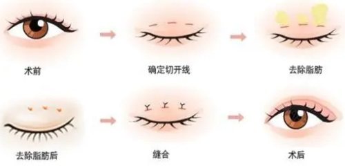 雙眼皮手術(shù)示意圖 雙眼皮手術(shù)示意圖