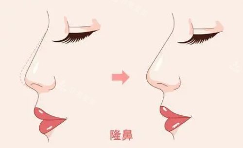 隆鼻前后對(duì)比圖 隆鼻前后對(duì)比圖