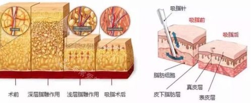 吸脂原理圖