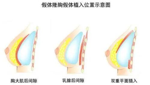 陈新平假体隆胸做的怎么样？整友评价胸型特别自然！