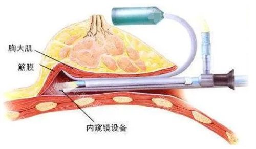 內(nèi)窺鏡隆胸示意圖