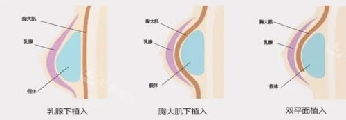 假體植入方法示意圖 假體植入方法示意圖