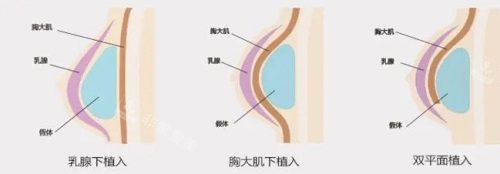 假体植入方法示意图