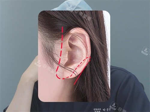 韩国Faceplus整形医院拉皮手术切口位置示意图