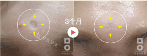 韓國美爾韓醫(yī)院3個月治療前后 韓國美爾韓醫(yī)院3個月治療前后