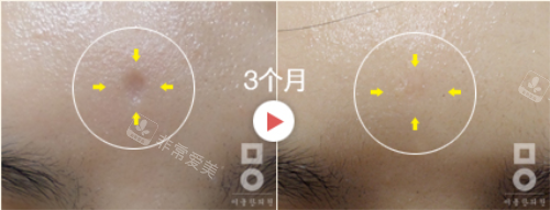 青春痘怎么消除?韩国美尔韩医院祛痘疤痕治疗快速而有效