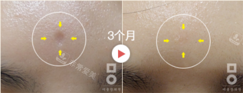 韓國美爾韓醫(yī)院凹陷性疤痕治療 韓國美爾韓醫(yī)院凹陷性疤痕治療