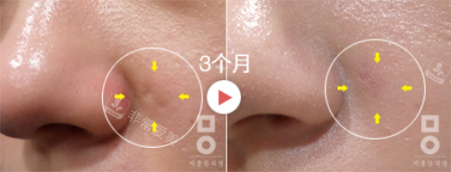 韓國美爾韓醫(yī)院背部凹陷疤痕治療 韓國美爾韓醫(yī)院背部凹陷疤痕治療