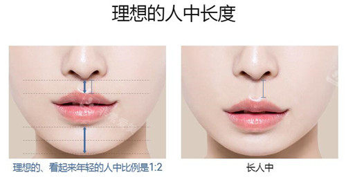 鼻下微創(chuàng)的人中縮小術(shù)圖示 鼻下微創(chuàng)的人中縮小術(shù)圖示