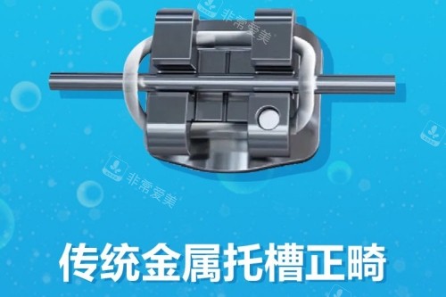 傳統(tǒng)托槽矯正展示圖 傳統(tǒng)托槽矯正展示圖