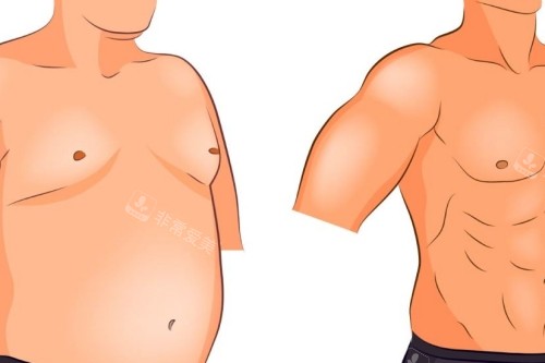男性胸部手术对比图