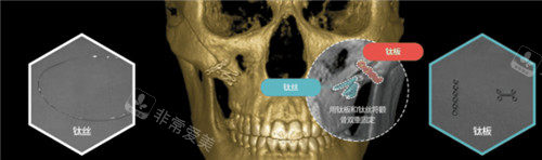 韩国ts整形外科颧骨手术方式图