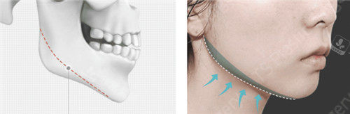 韩国ts整形外科下颌角手术切除图片
