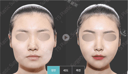 韩国ts整形外科轮廓手术照片