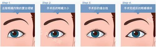 雙眼皮整形示意圖 雙眼皮整形示意圖