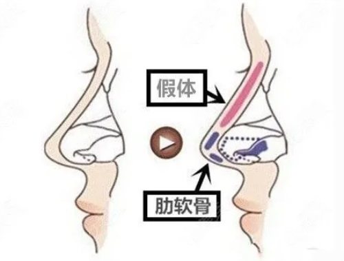 隆鼻示意图