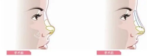 隆鼻示意图 隆鼻示意图