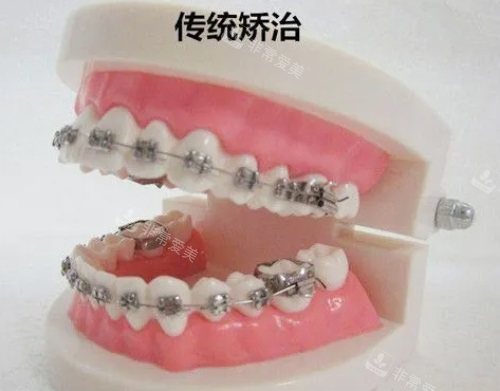 牙齿矫正示意图 牙齿矫正示意图