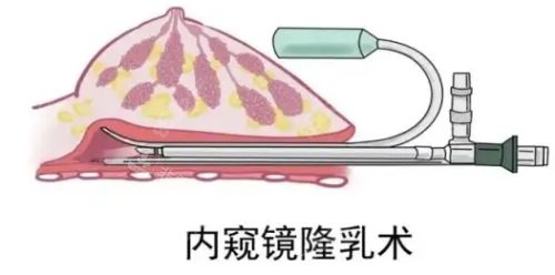 内窥镜隆胸示意图