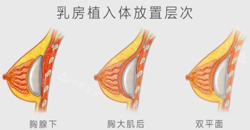 隆胸假體植入位置示意圖