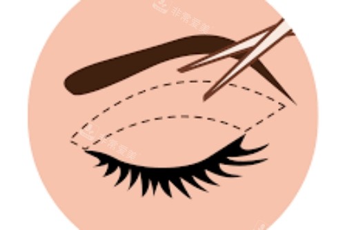 眼部手術(shù)卡通圖