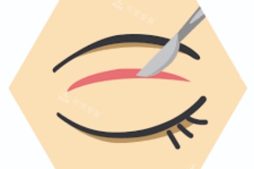 眼部手術(shù)示意圖
