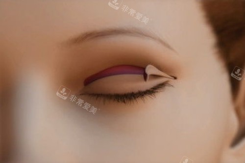 雙眼皮手術(shù)展示圖 雙眼皮手術(shù)展示圖