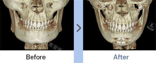 韩国1%整形外科下颌角下巴ct图