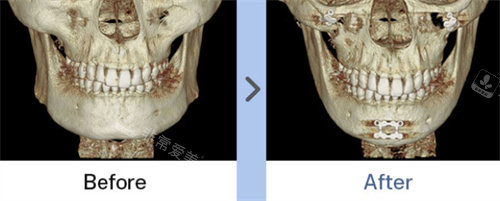 韓國1%整形外科下頜角下巴ct圖