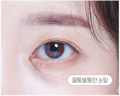韩国温度整形做眼底脂肪重排不止消灭黑眼圈,对抗衰也有利