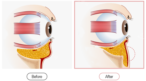 眼底脂肪重排卡通图
