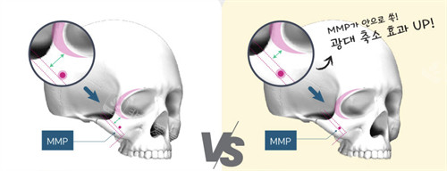韓國歐佩拉整形外科顴骨手術(shù)特點圖解