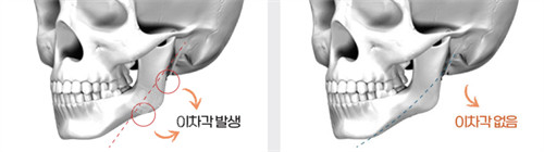 韓國歐佩拉整形外科下頜角手術(shù)解析圖