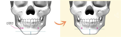 韓國歐佩拉整形外科下巴整形手術(shù)解析圖