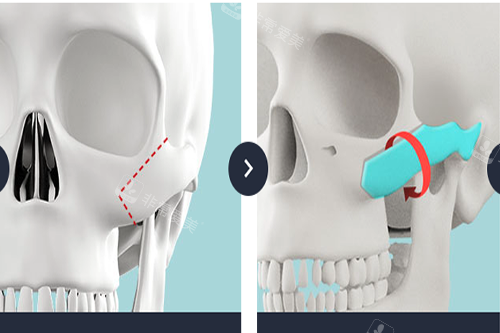 韩国TS整形外科医院L型截骨示意图