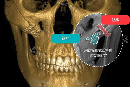 韩国TS整形外科双重固定术示意图