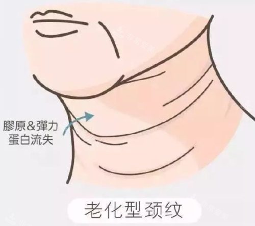 老化型頸紋示意圖 老化型頸紋示意圖