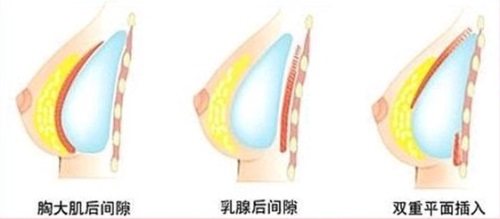 雙平面假體隆胸術(shù)示意圖 雙平面假體隆胸術(shù)示意圖