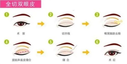 全切雙眼皮示意圖 全切雙眼皮示意圖