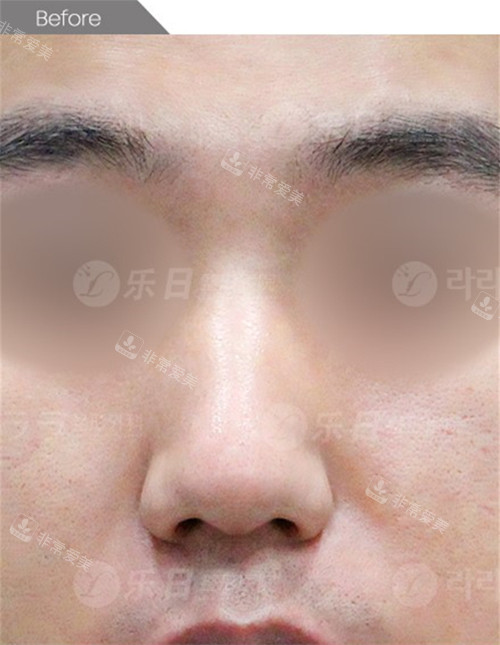 韩国乐日lara整形外科鼻整形术前 韩国乐日lara整形外科鼻整形术前