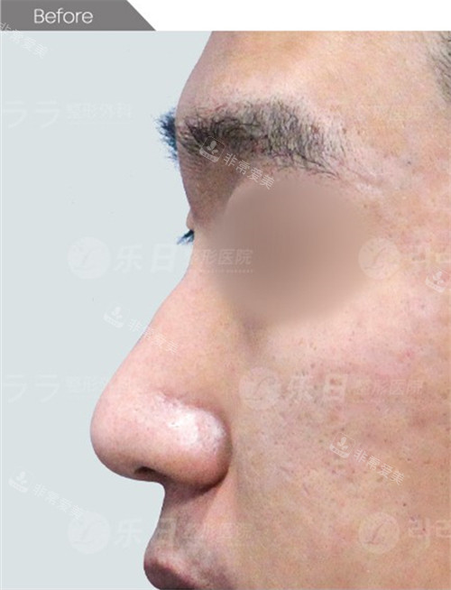韩国乐日lara整形外科鼻整形术前侧面图
