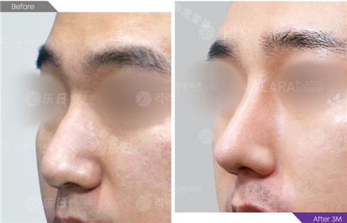 韩国乐日lara整形外科鼻整形前后对比