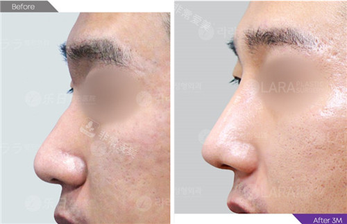 韩国乐日lara整形外科鼻整形前后图